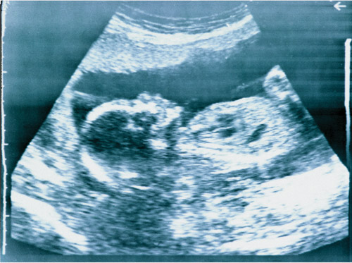 Midwifery Essays
