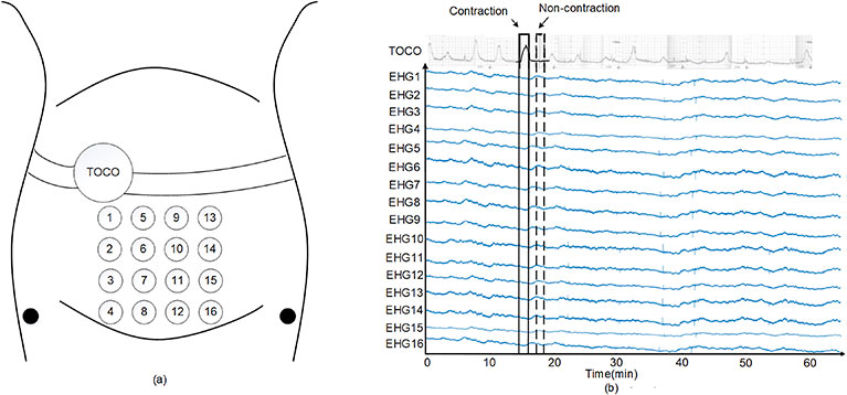 Figure for EHG recording